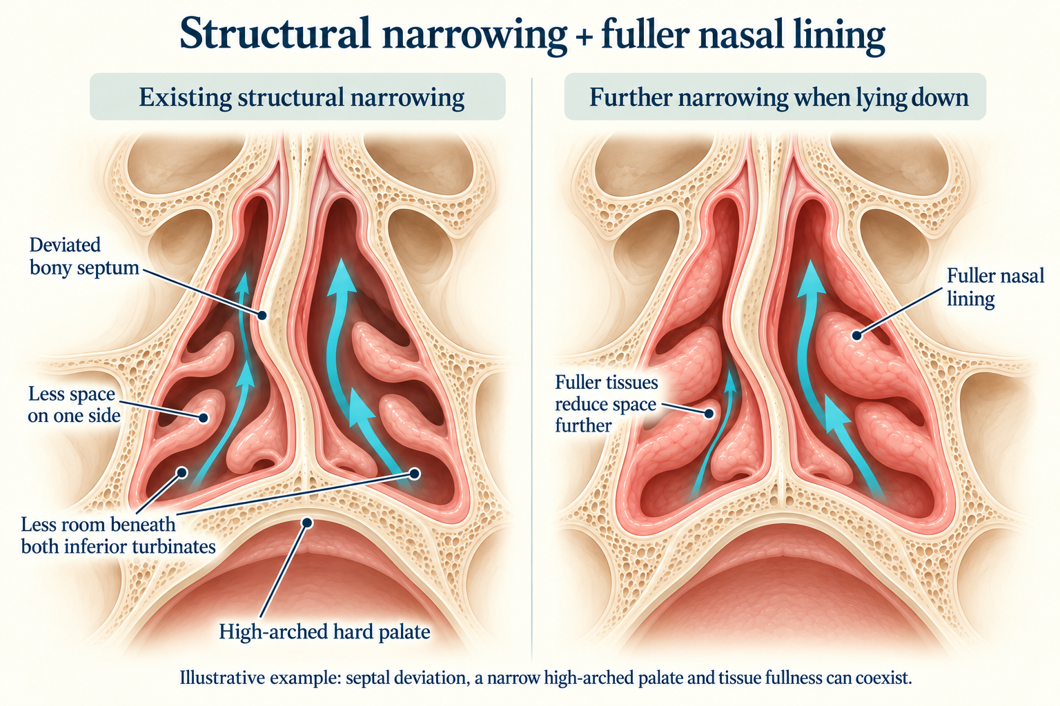 Illustrative nasal cross-sections showing a deviated bony septum and high-arched hard palate in both panels, with fuller nasal lining further reducing air space in the right panel.